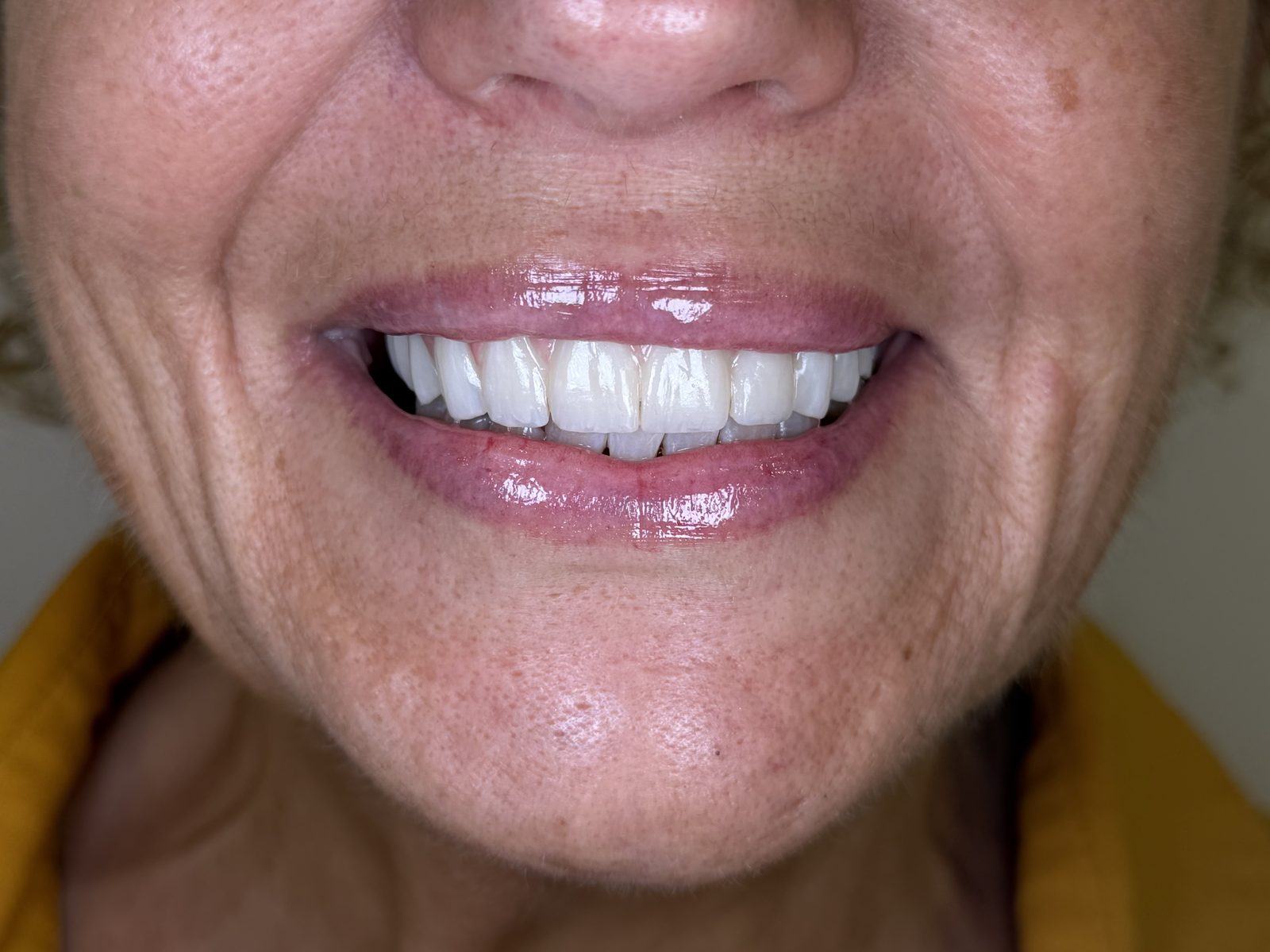 After All on X dental implants in Plantation FL, patient with a full arch implant supported smile
